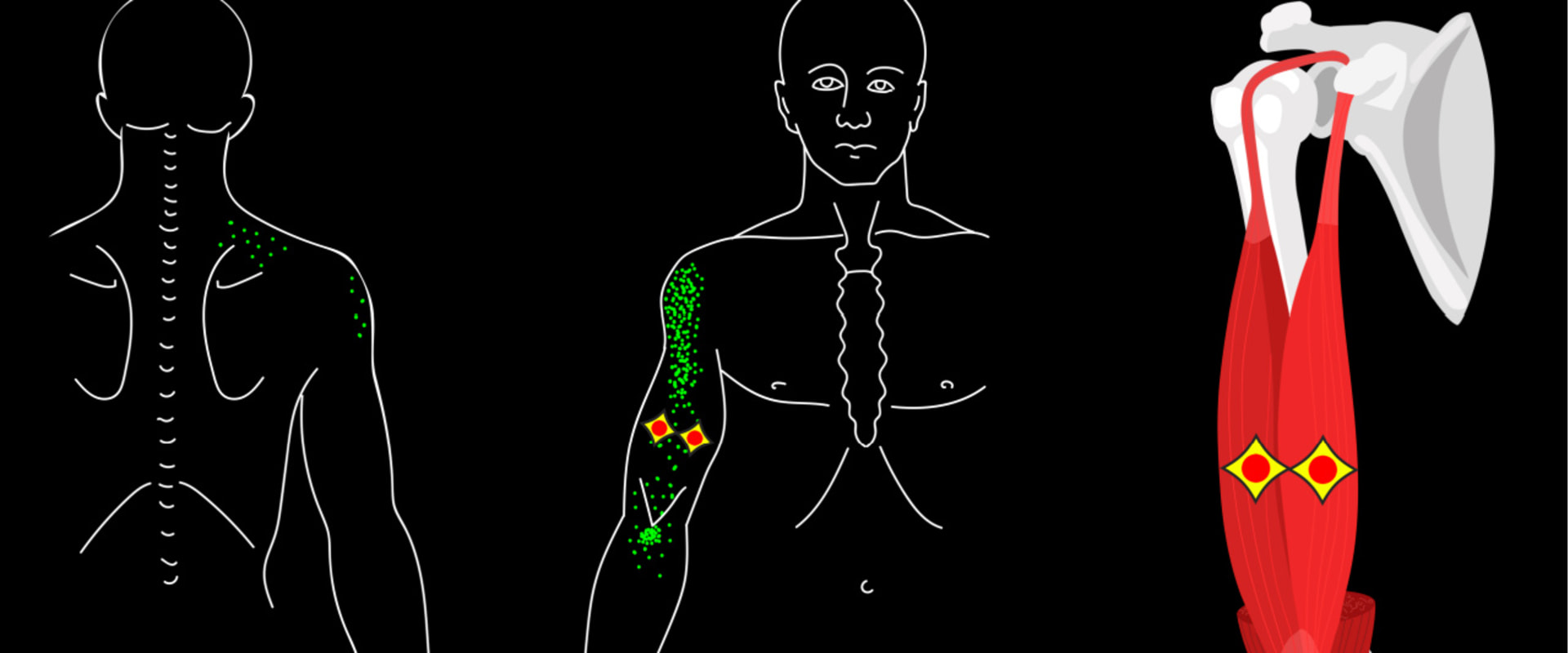 how-long-does-trigger-point-injection-therapy-last